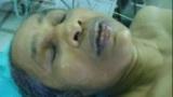Thyroid Surgery Video by Dr Santanu Bhattacharjee Kolkata